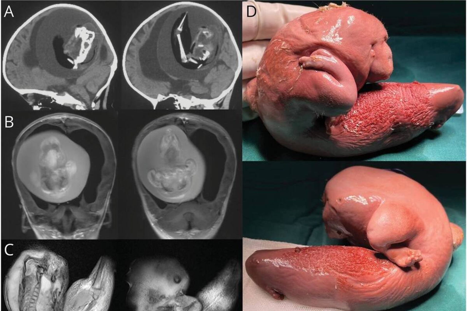 جنین در سر کودک یک ساله