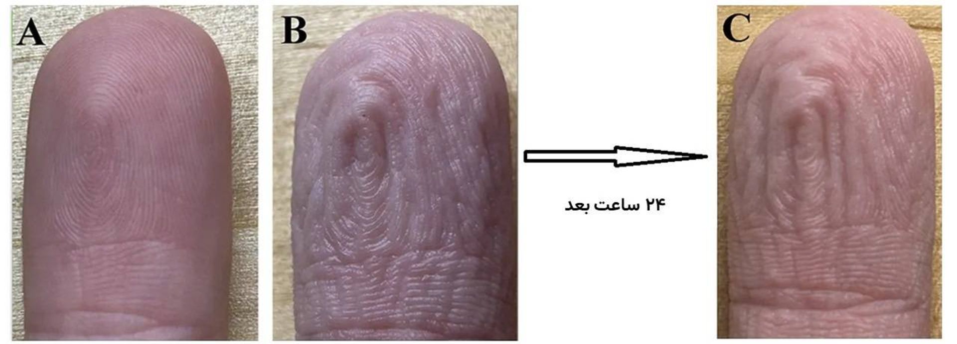 چروکیده شدن انگشتان در آب