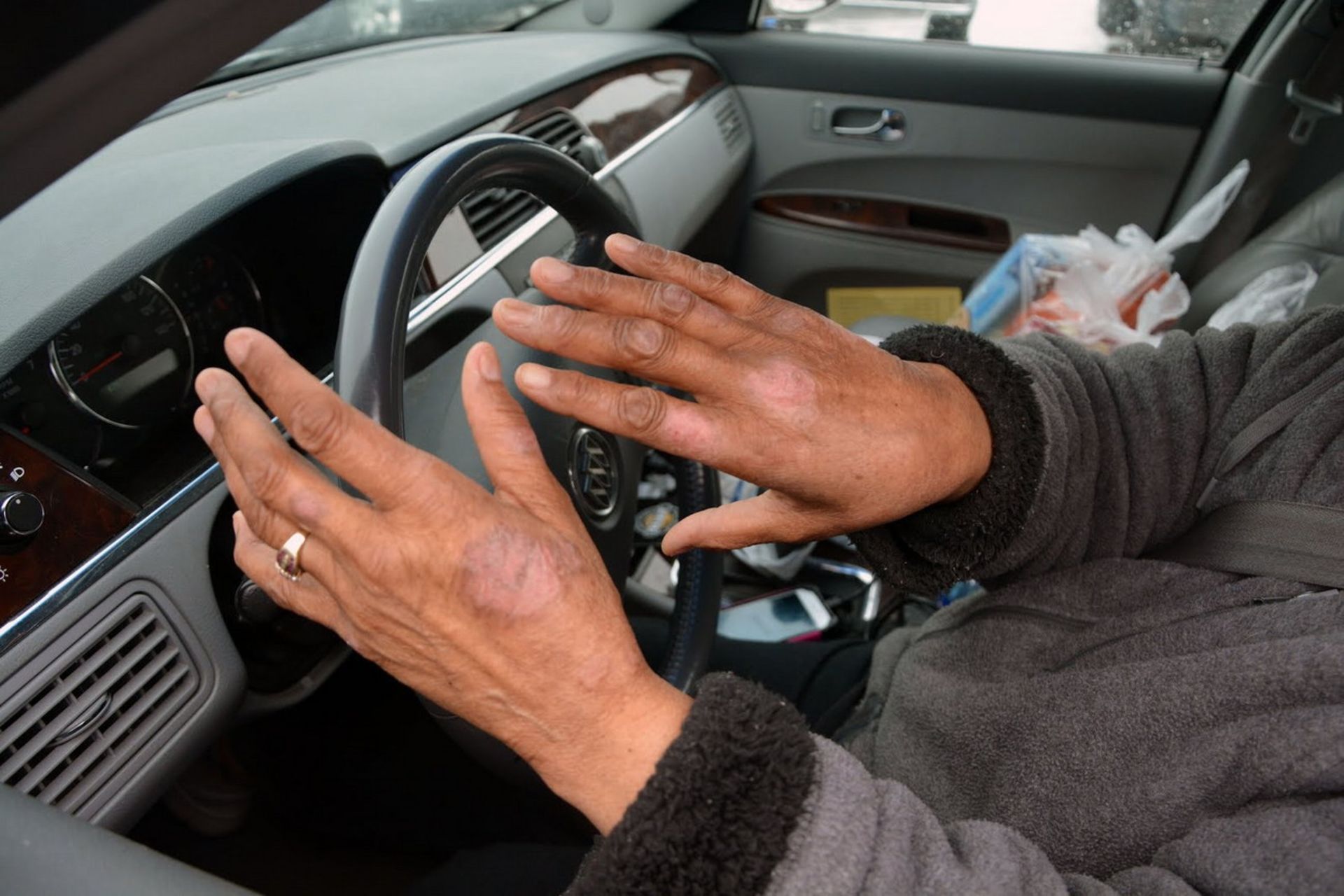 بثورات پوستی دست‌های زنی در فلینت