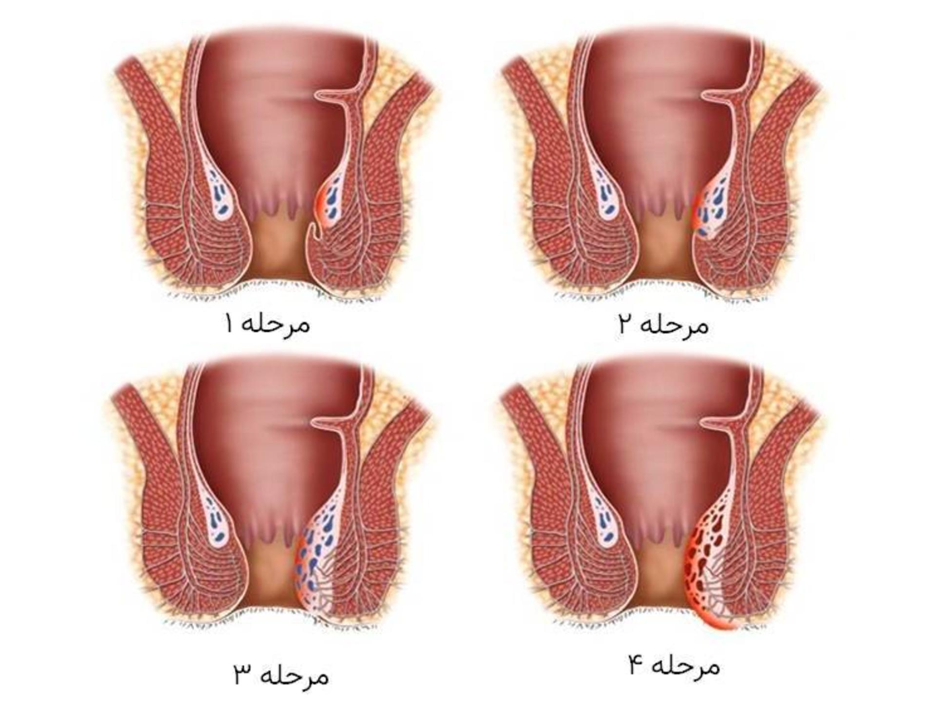 مراحل هموروئید