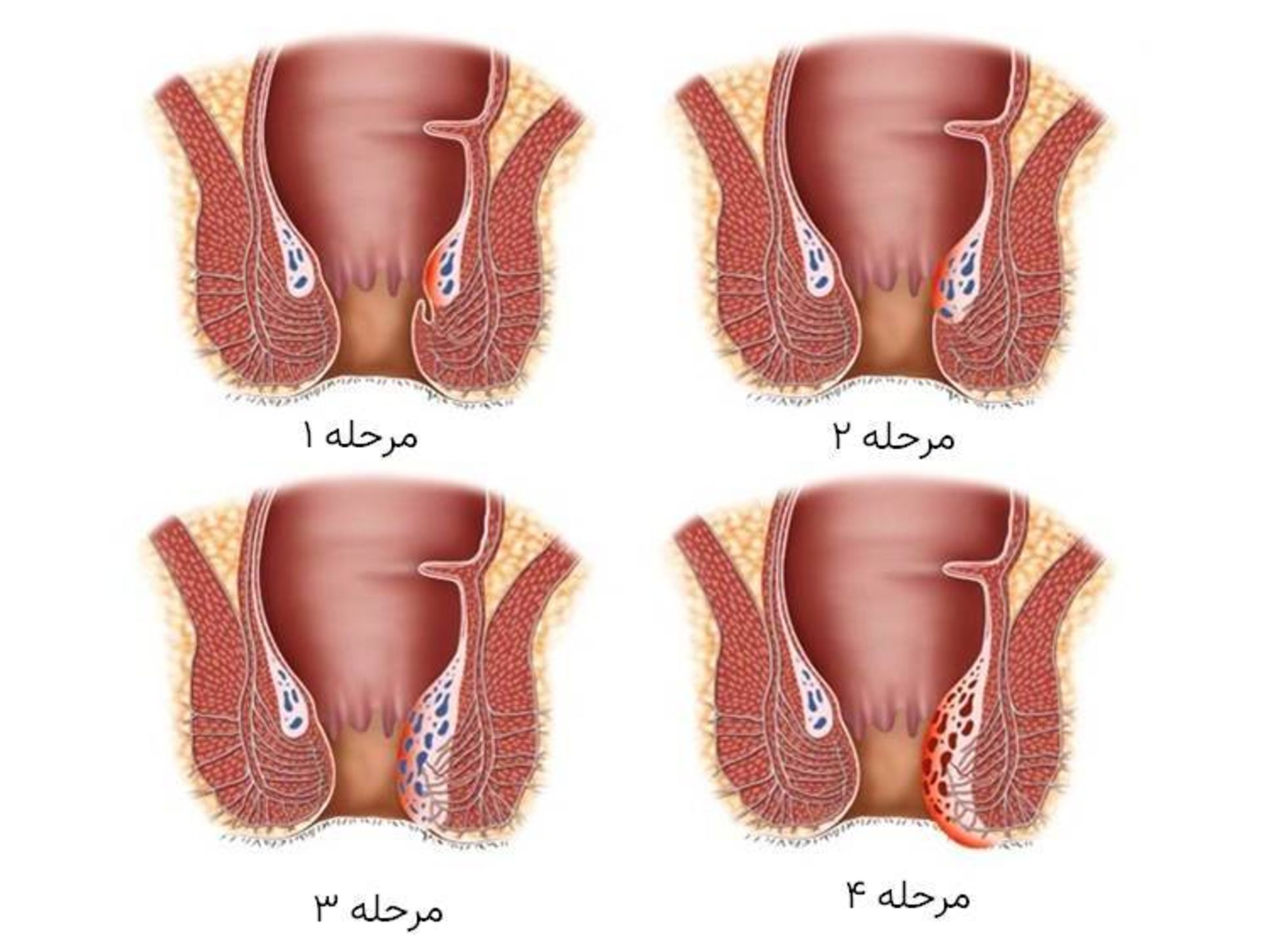 مراحل هموروئید