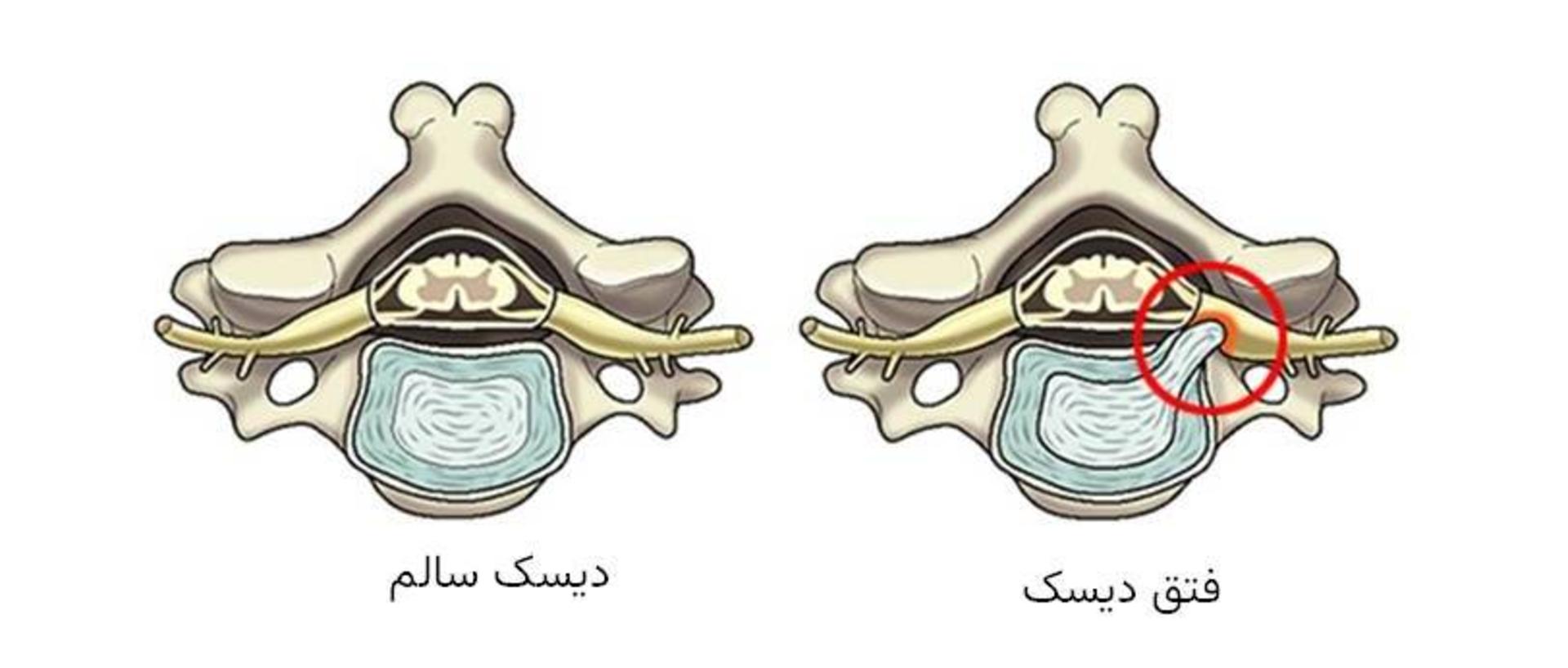 فتق دیسک
