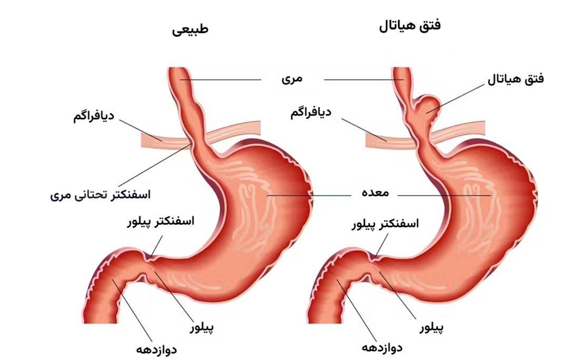 فتق هیاتال