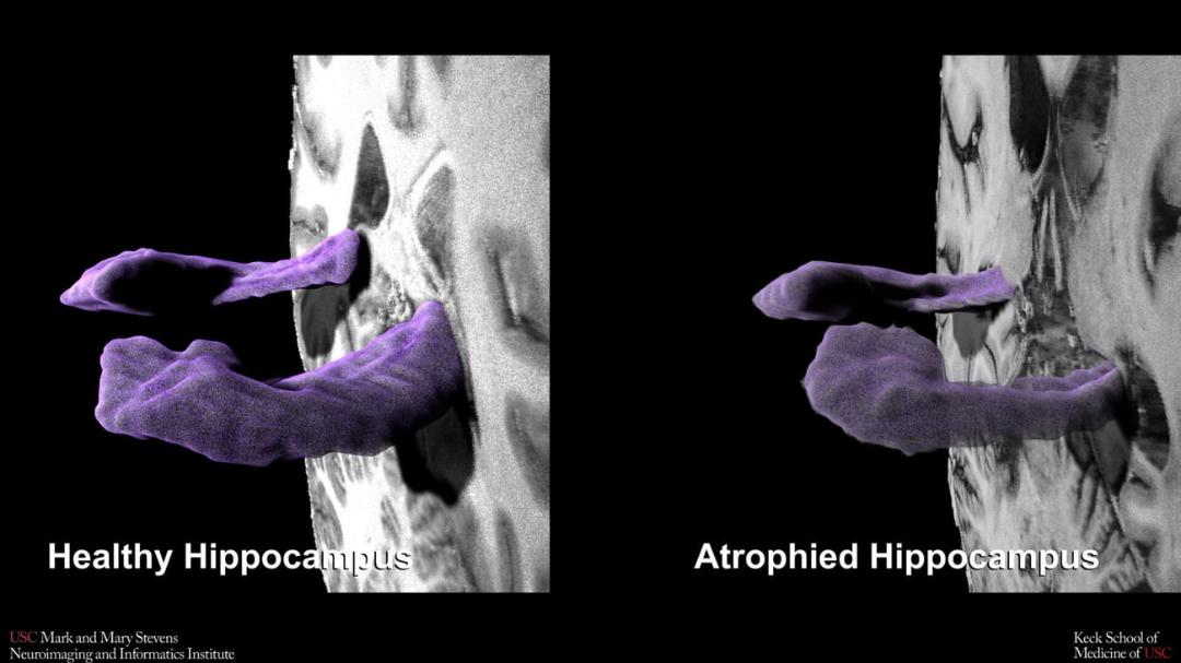 مقایسه ساختار هیپوکامپ (Hippocampus) سالم و تحلیل‌رفته در اسکن مغز