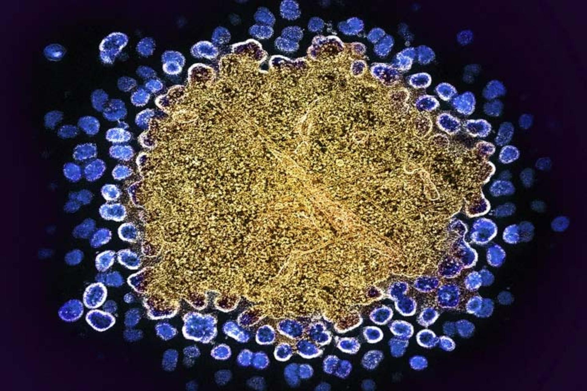 ورود HIV به سلول های ایمنی