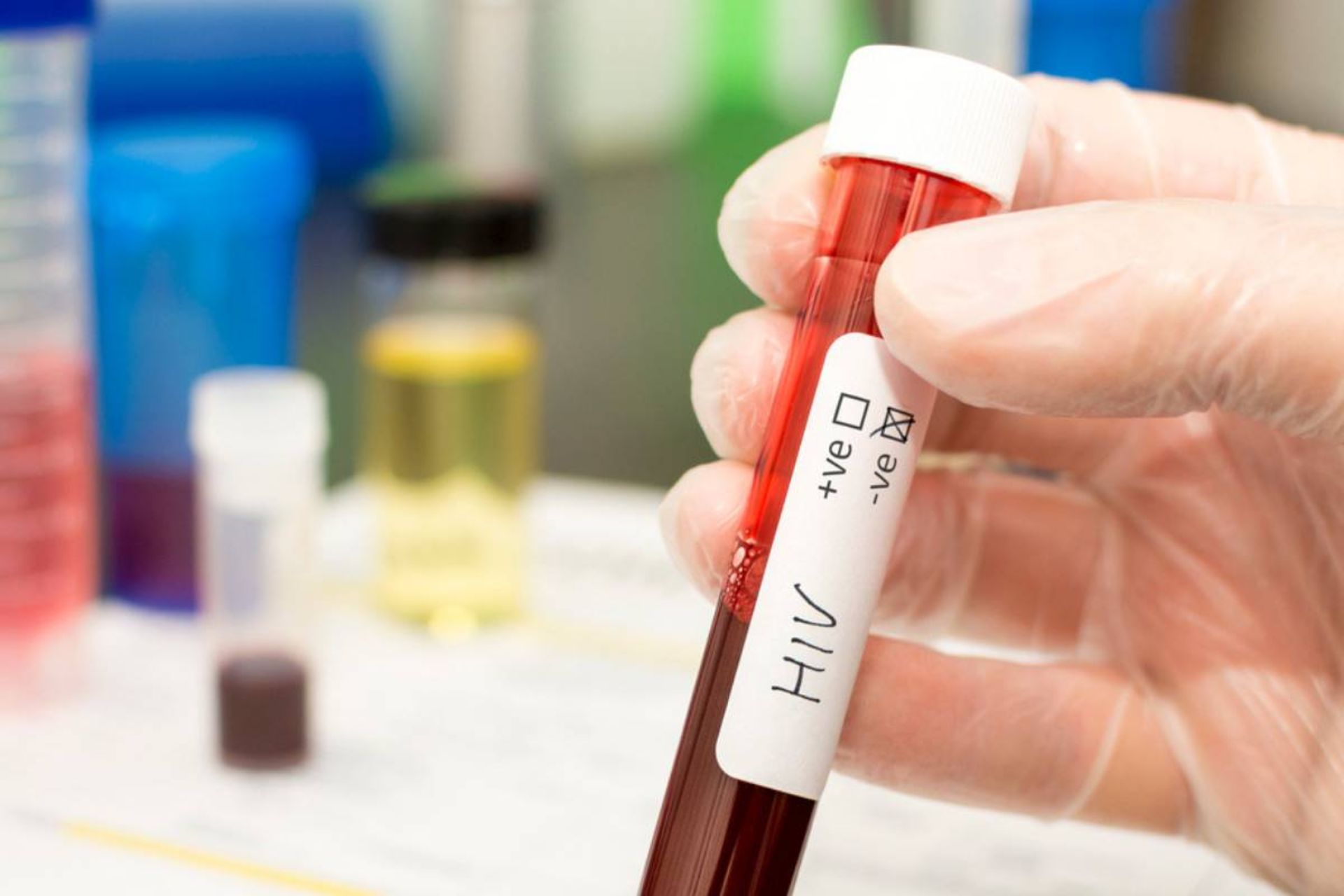 تست اچ آی وی