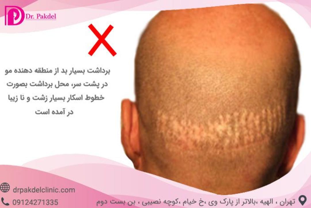 کاشت مو