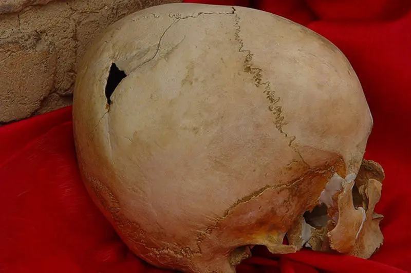 جراحی جمجمه شهرسوخته