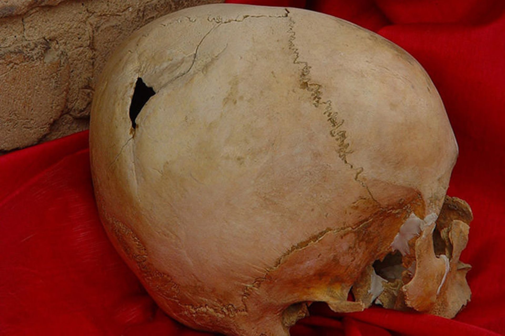 جراحی جمجمه شهرسوخته