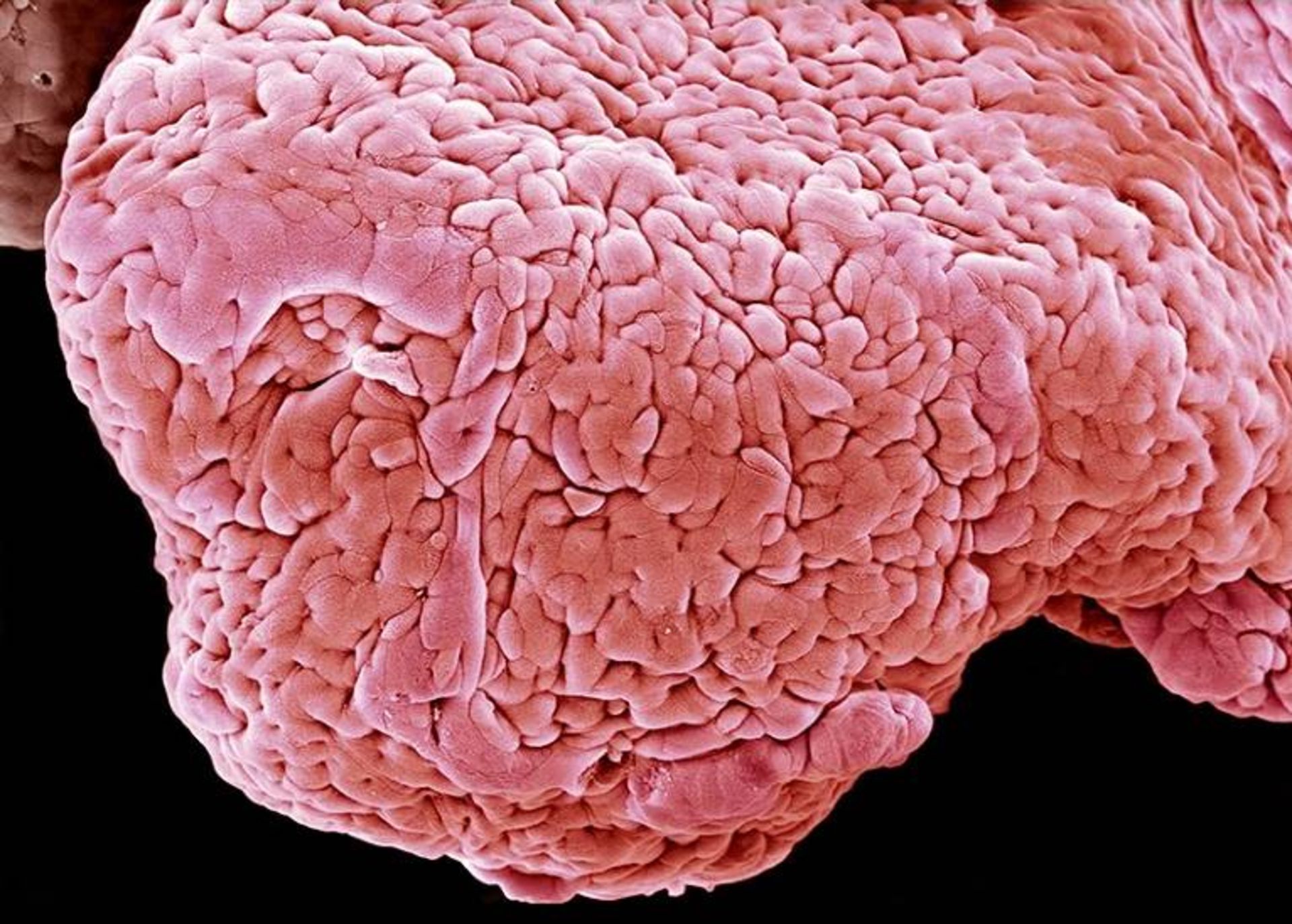 بافت روده بیمار  مبتلا به کولیت زخمی 