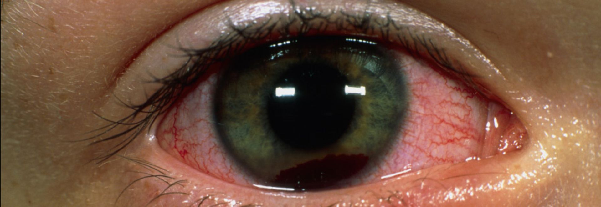 هایفما و تاری دید