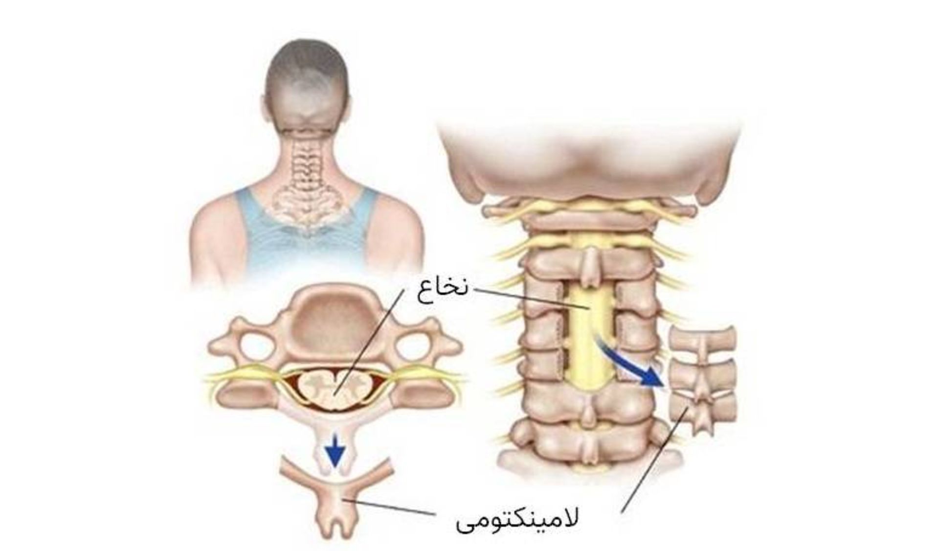 لامینکتومی