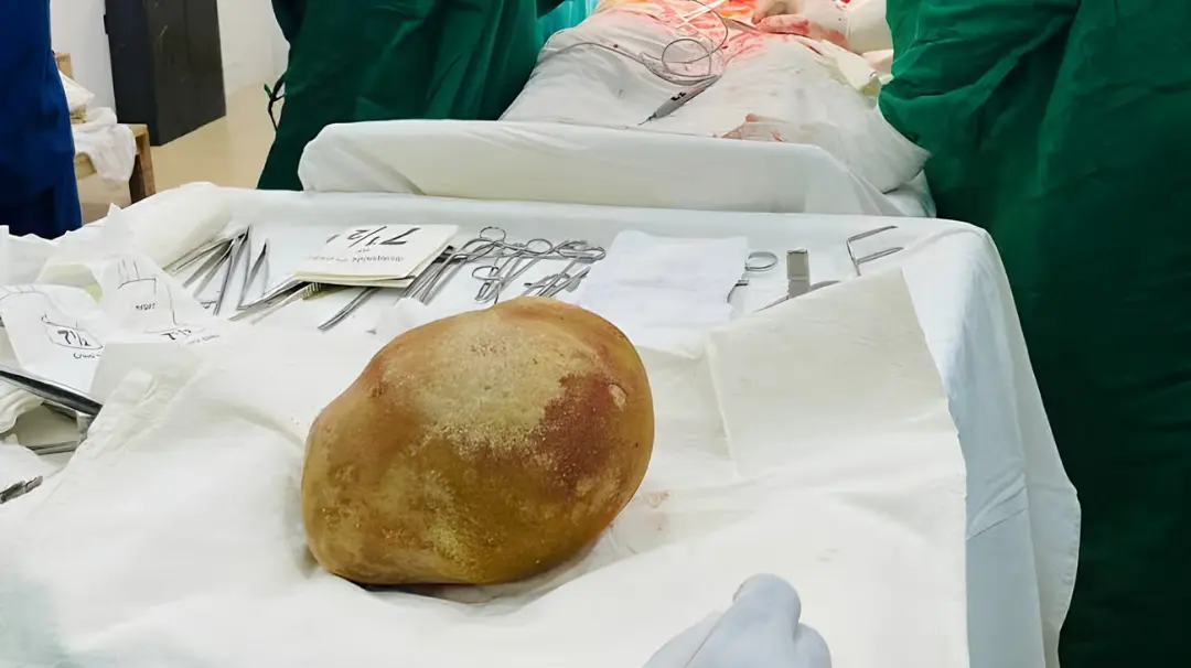 سنگ مثانه بسیار بزرگ خارج شده از بدن بیمار روی میز جراحی