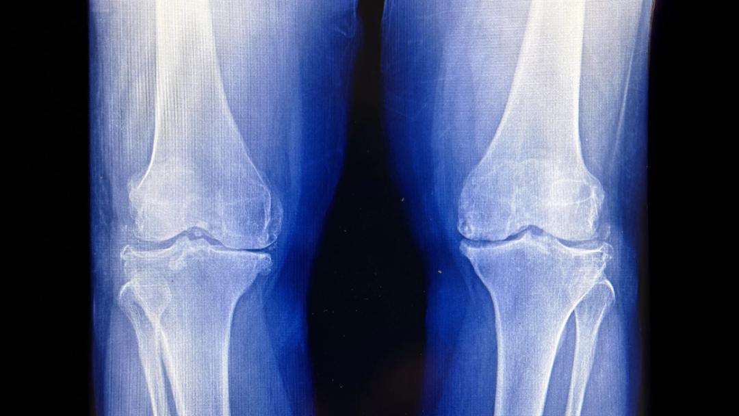 تصویر X-ray پرتودرمانی زانو با دوز پایین