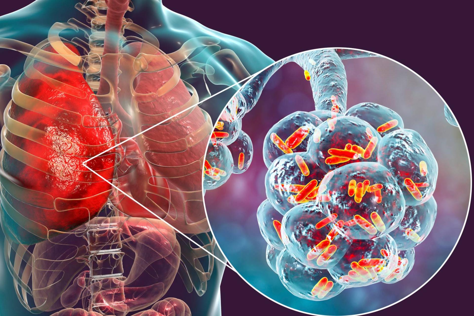 انواع عفونت ریه و درمان آن ها