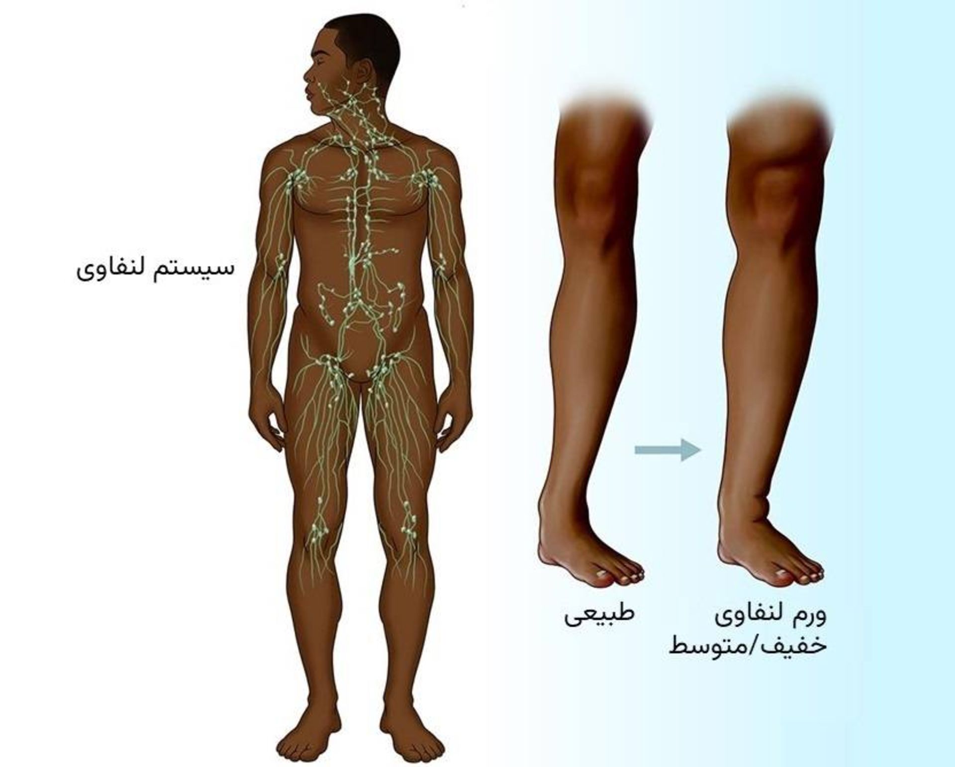 سیستم لنفاوی و ورم لنفاوی