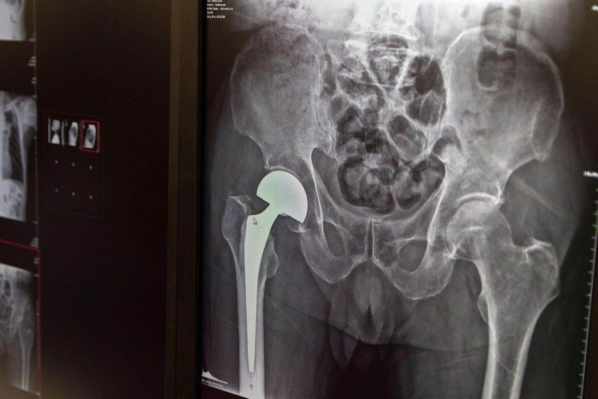 خطر شکستگی لگن در گیاهخواران ۵۰ درصد بیشتر از افراد دیگر است