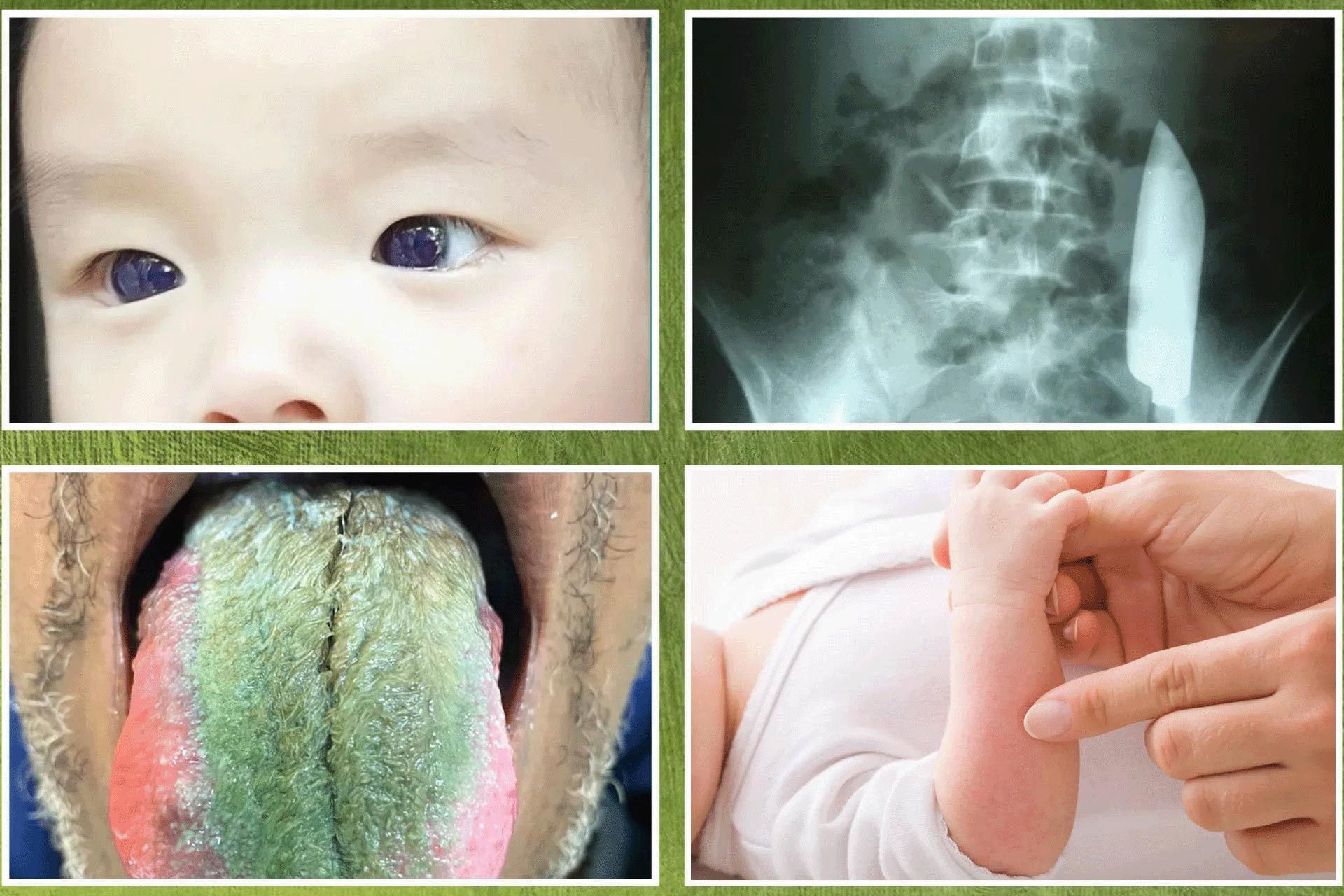 کلاژ چهره نوزاد، زبان عجیب سبز، تصویر پرتو ایکس و دست سرخ کودک