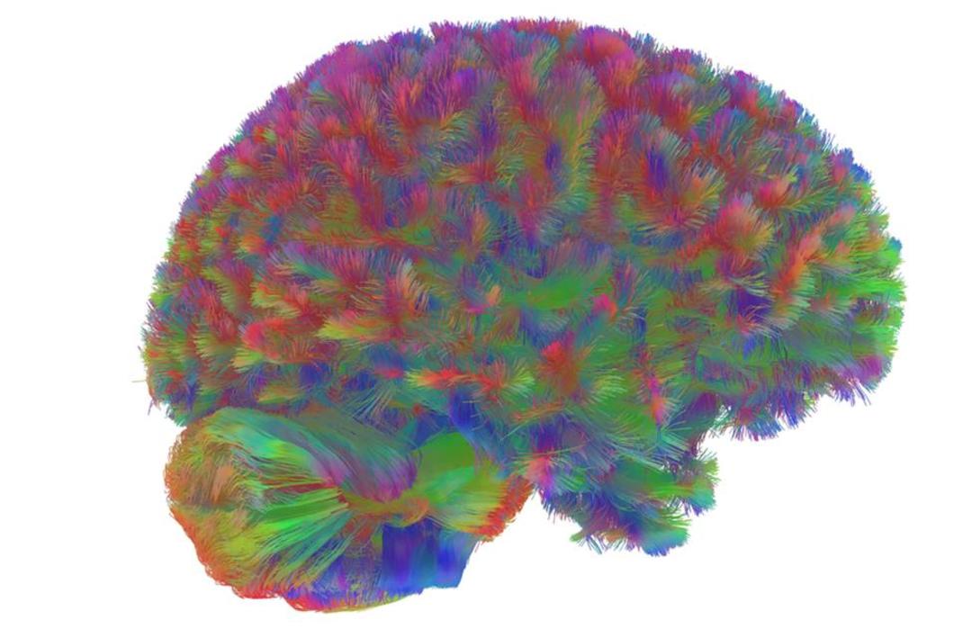 تراکتوگرافی MRI مغز انسان