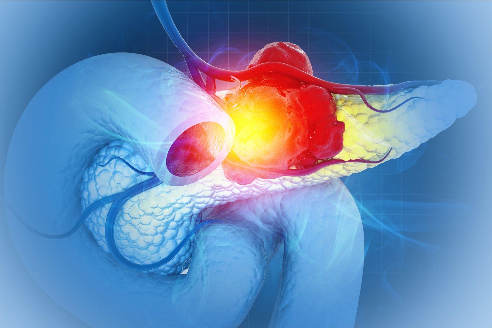 تصویرسازی پانکراس آلوده به تومور سرطانی