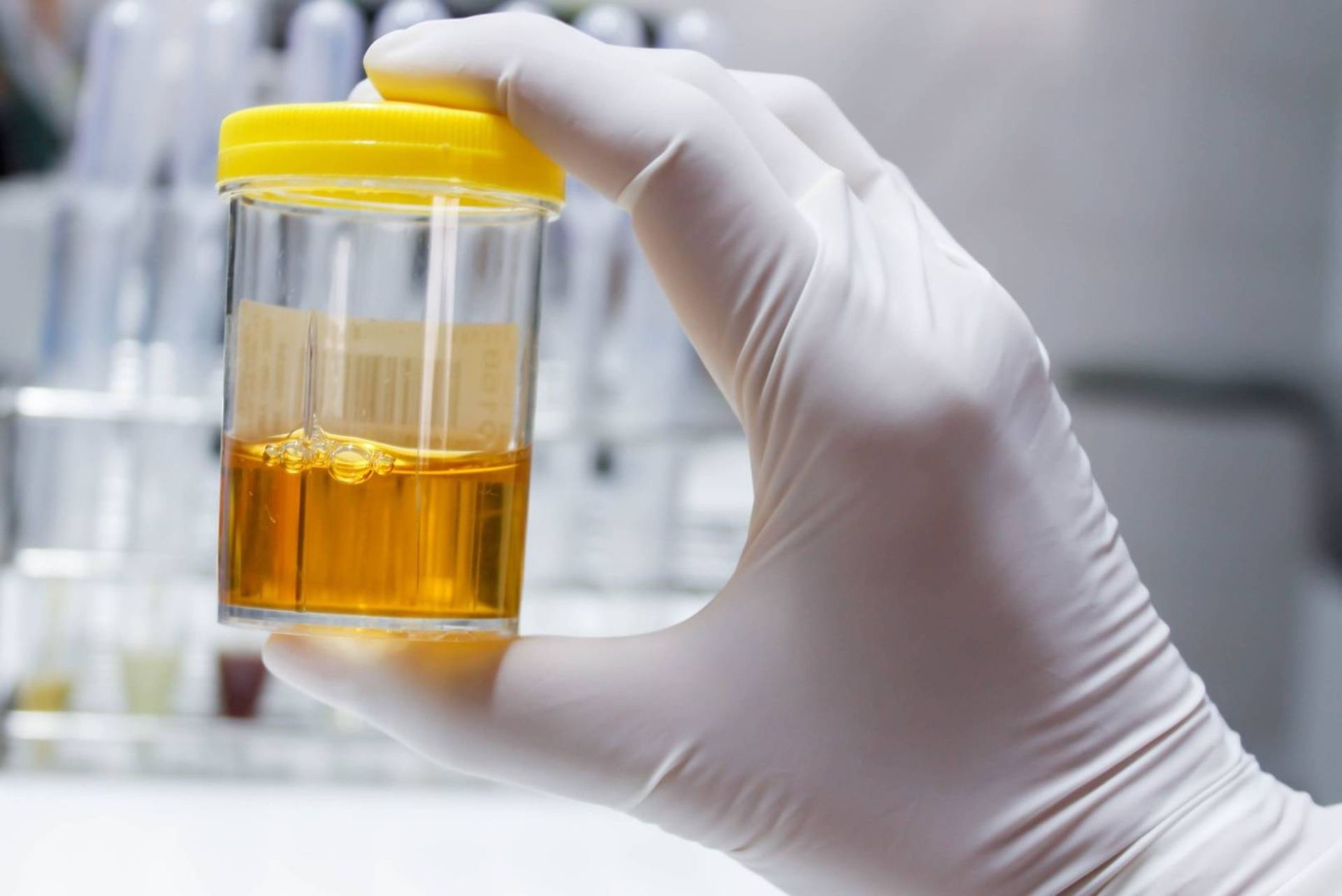 نمونه ادرار