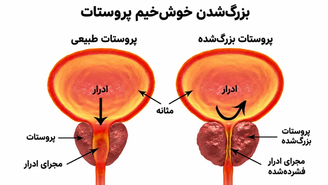 مقایسه ساختار پروستات طبیعی و پروستات بزرگ‌شده در کنار مثانه