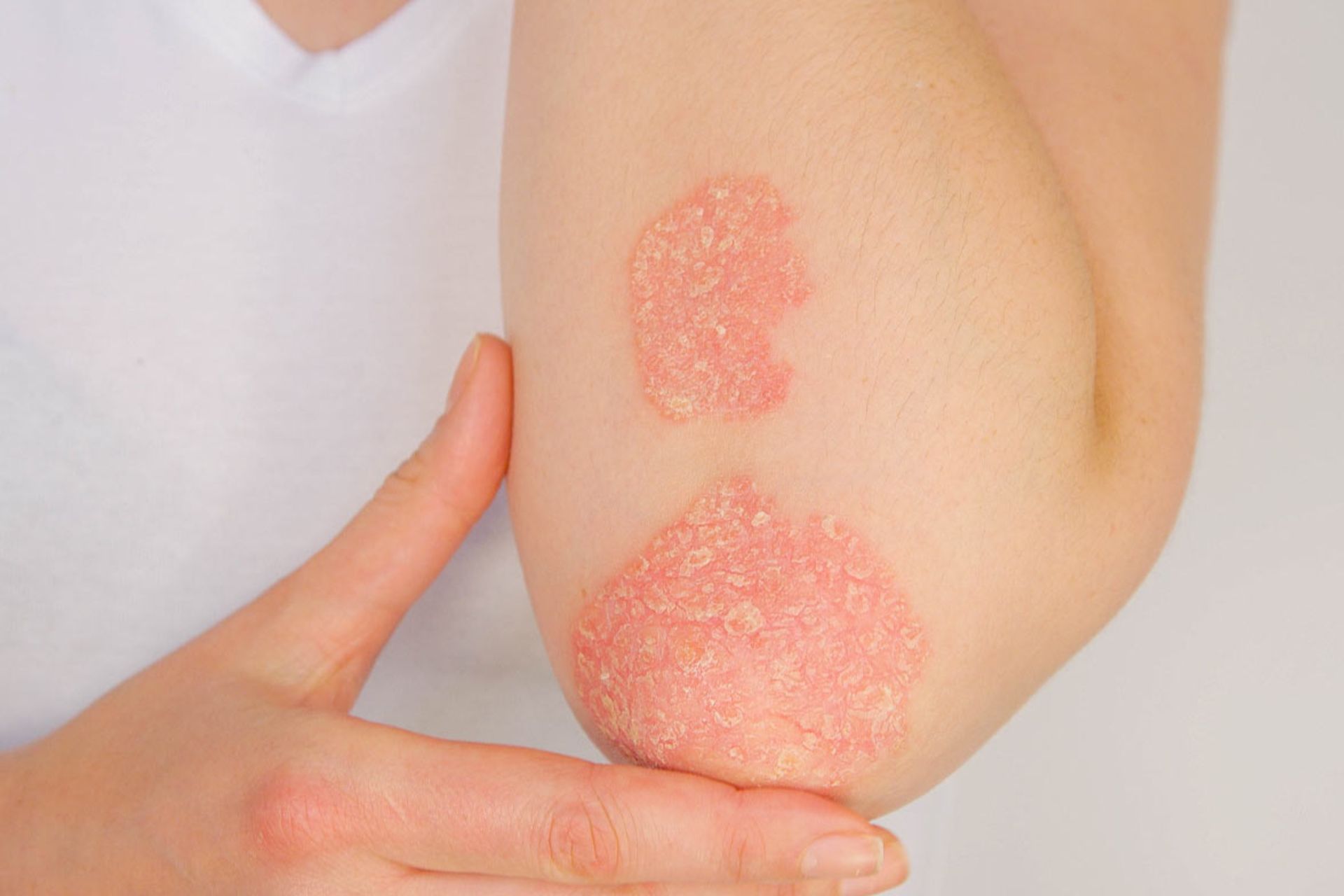 Psoriasis(پسوریازیس) 