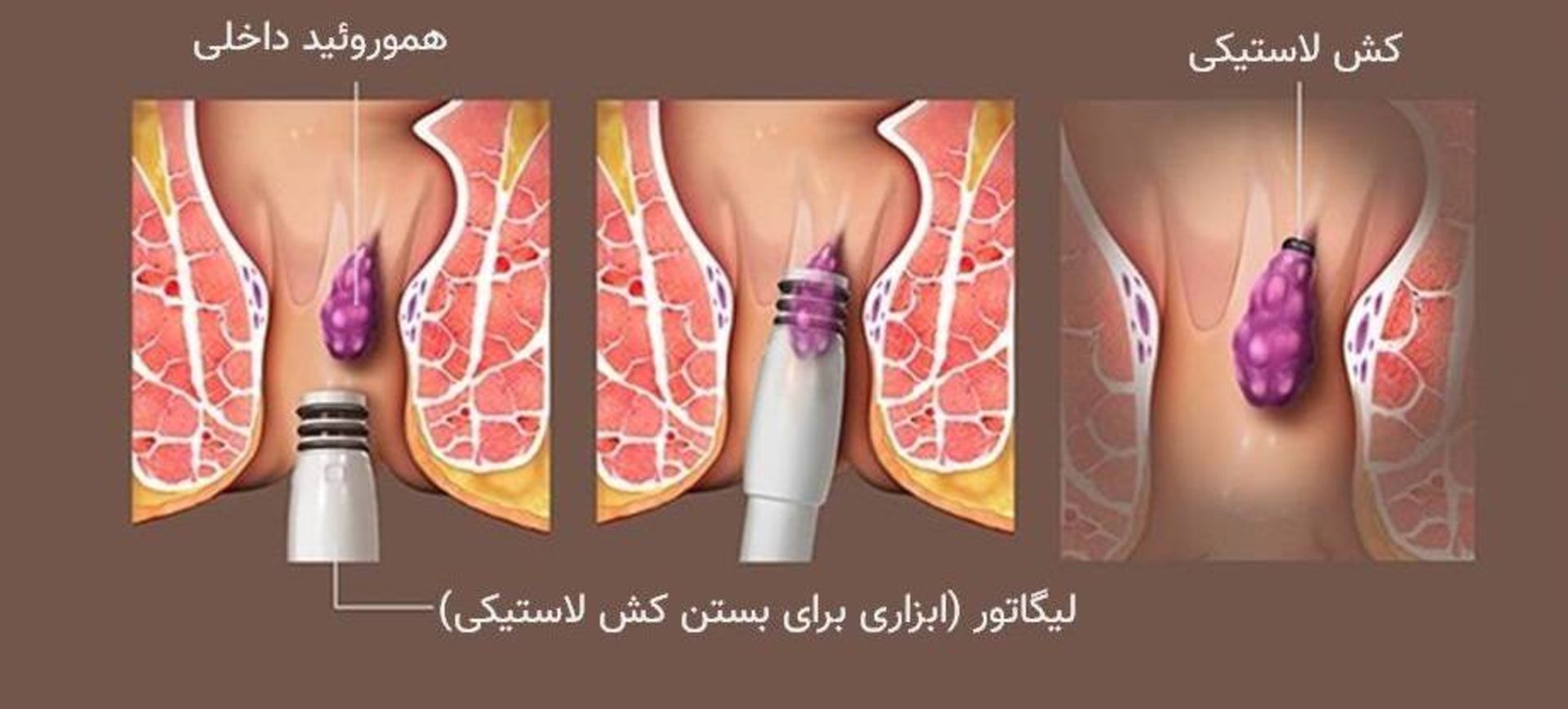 درمان بواسیر با بستن کش لاستیکی