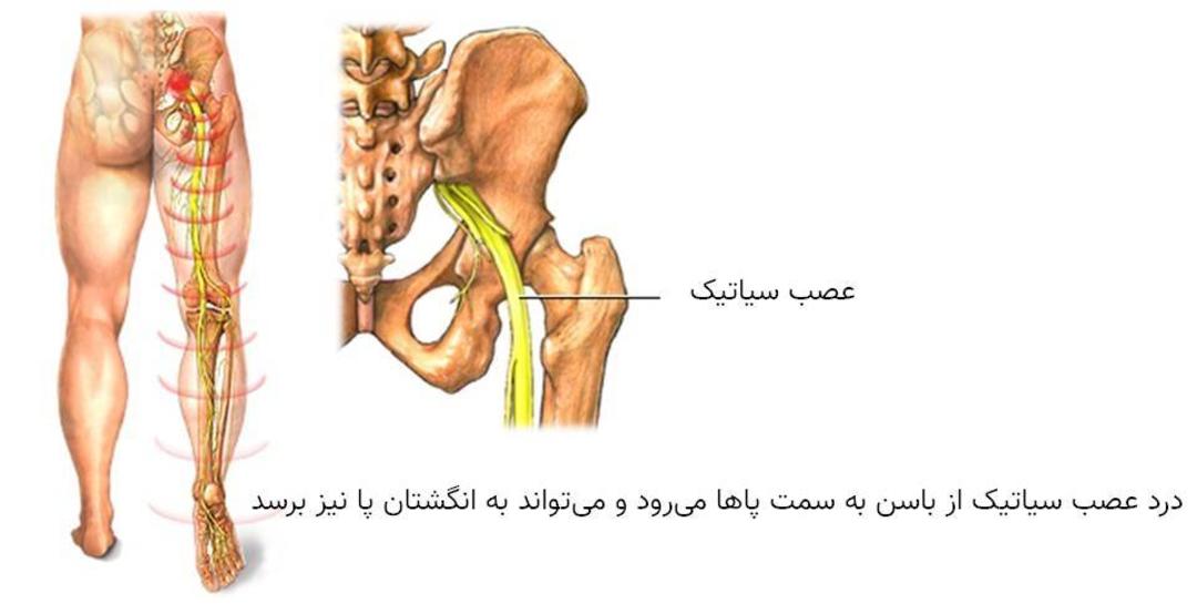 سیاتیک