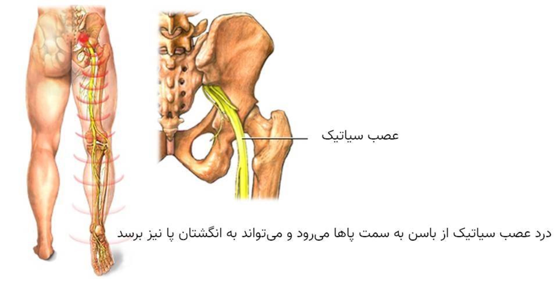 سیاتیک