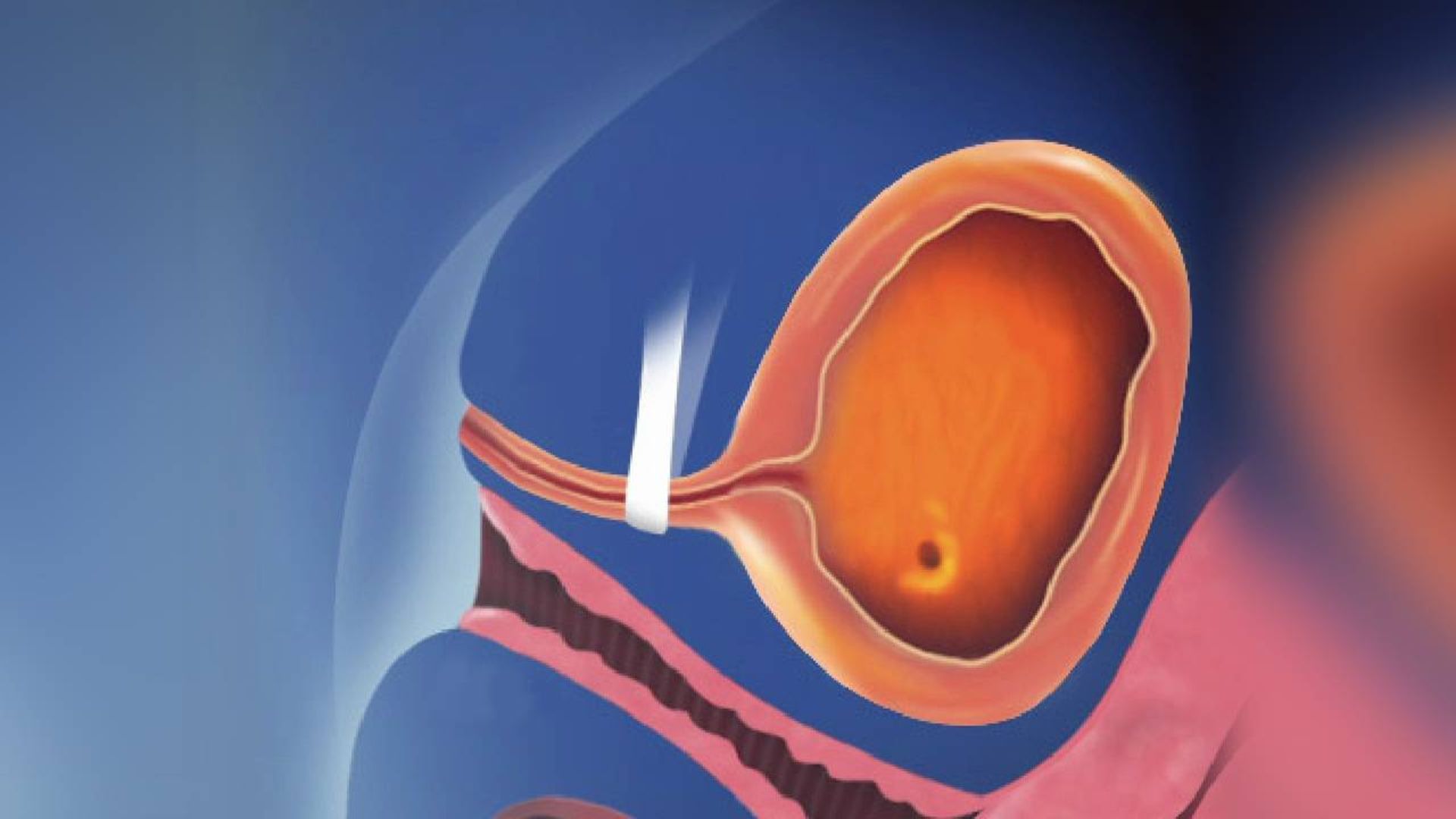  اسلینگ گذاری برای درمان بی اختیاری