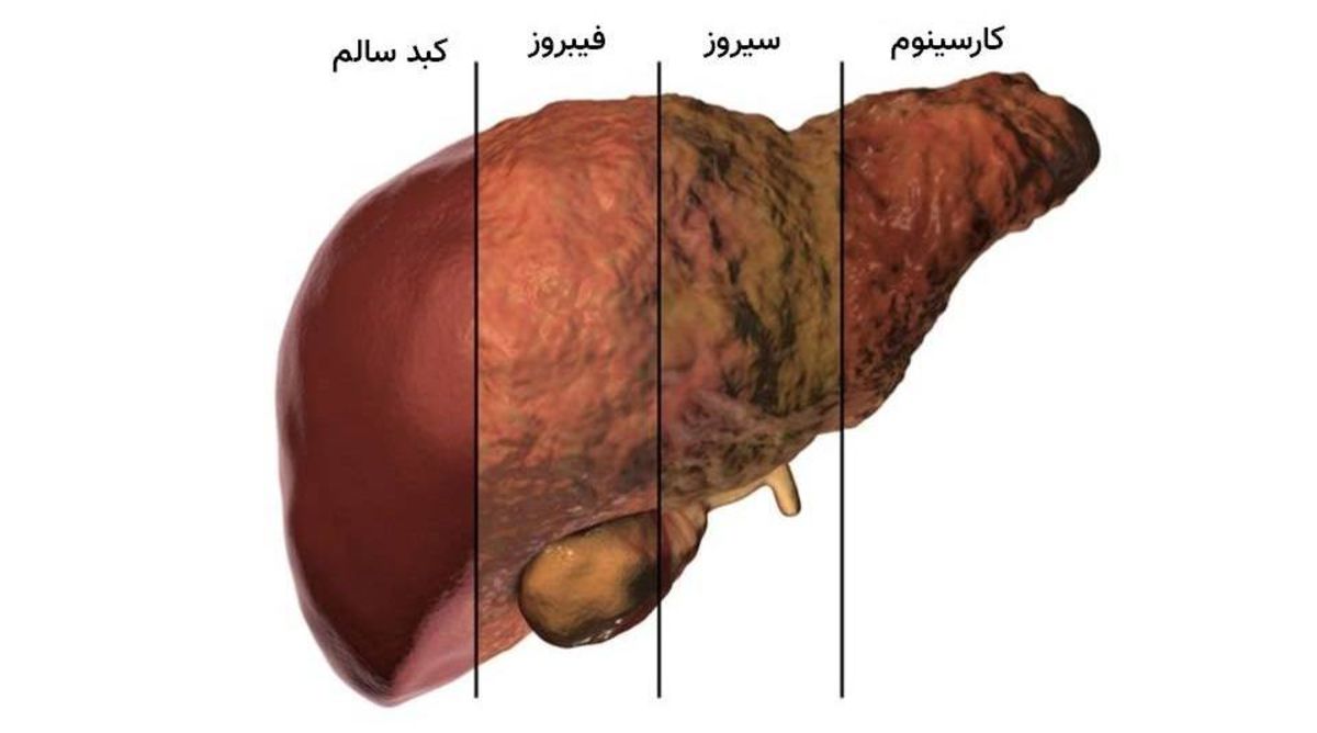 مراحل آسیب و بیماری های کبدی