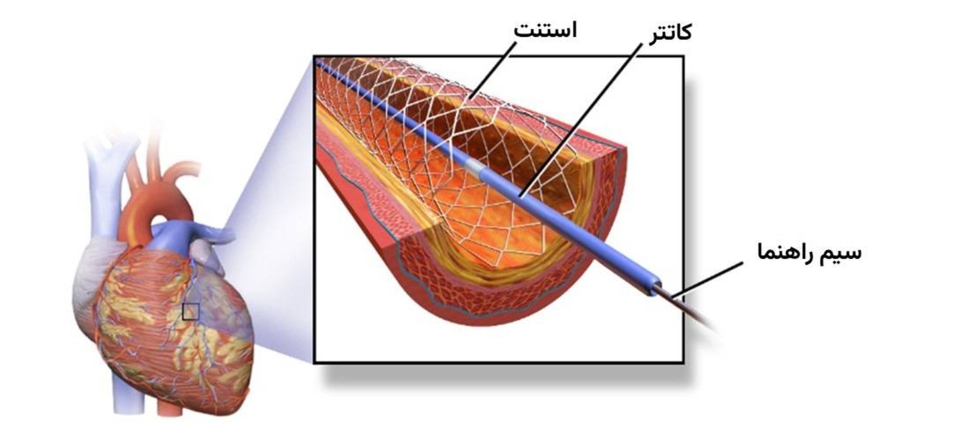 استنت گذاری