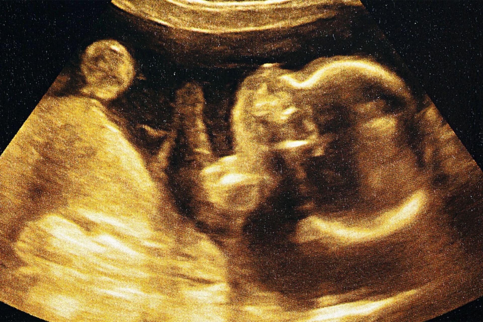 تصویر آرشیوی از نوزاد در رحم