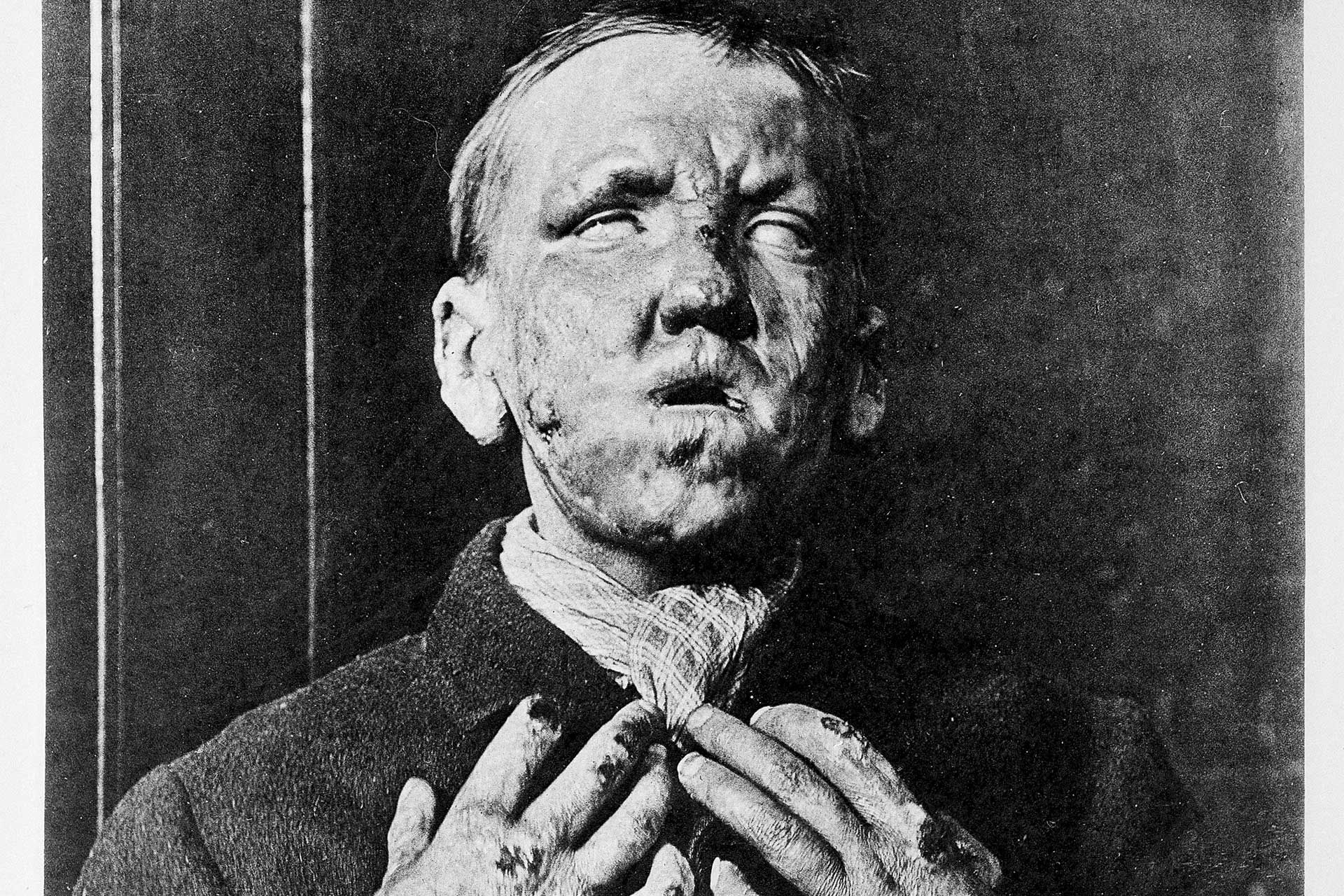 نمای نزدیک از چهره پسر جوانی مبتلا به بیماری جذام