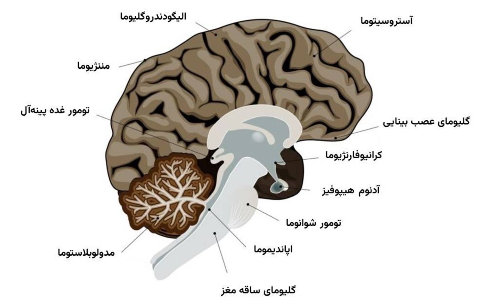 تومورهای اولیه مغزی