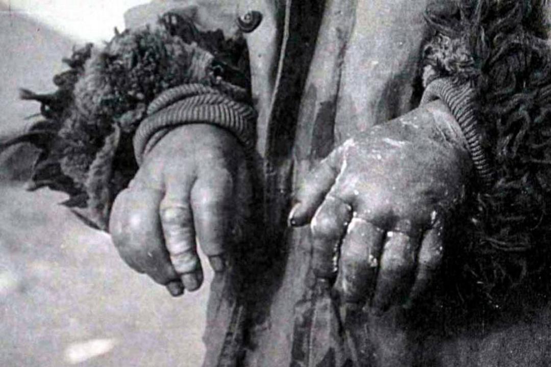 اثرات داروهای مختلف روی اندام‌های سرمازده اسیران واحد ۷۳۱ 