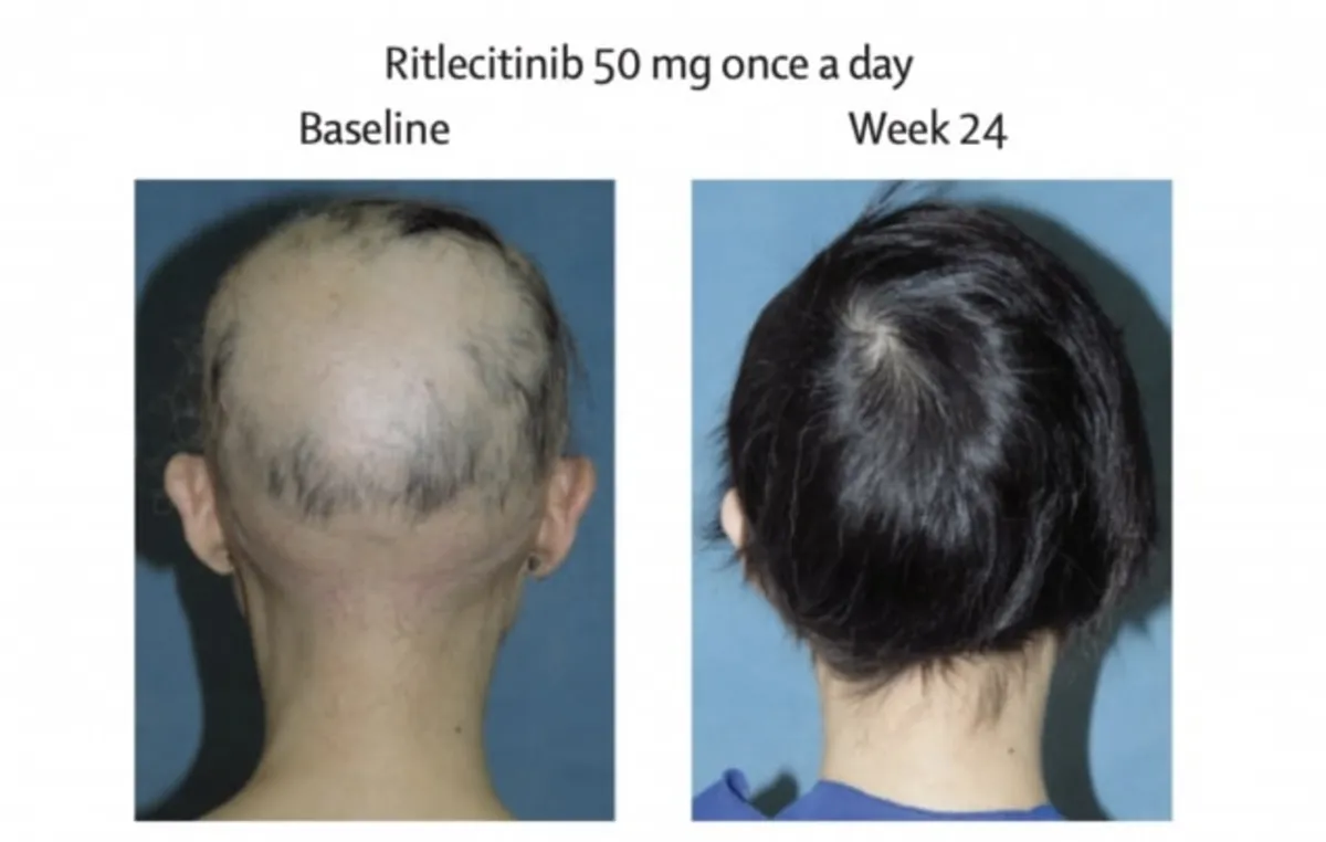رشد مجدد مو پس از مصرف داروی جدید آلوپسی