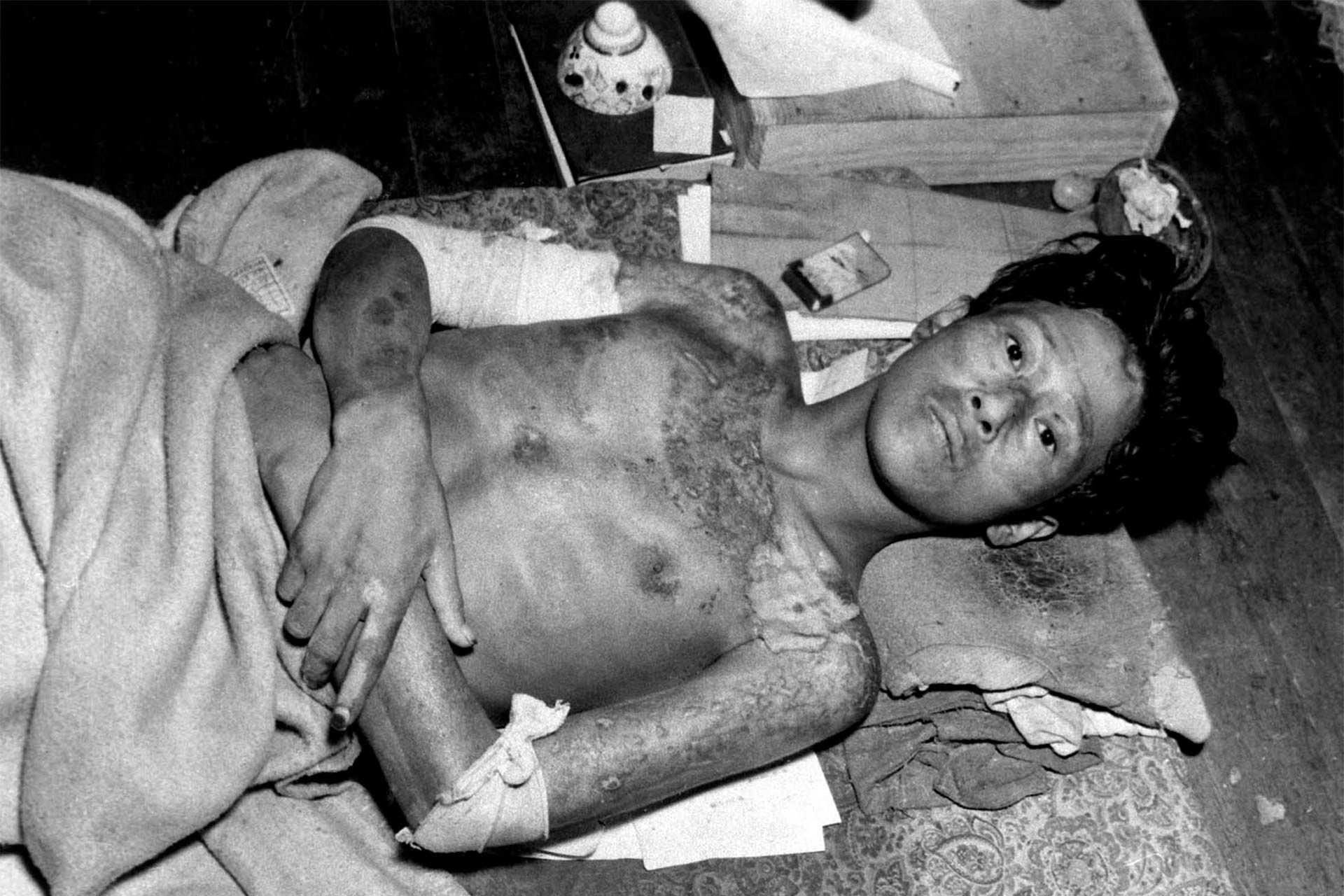 مرد قربانی بمب اتم منفجرشده برفراز ناگاساکی ژاپن در بستر
