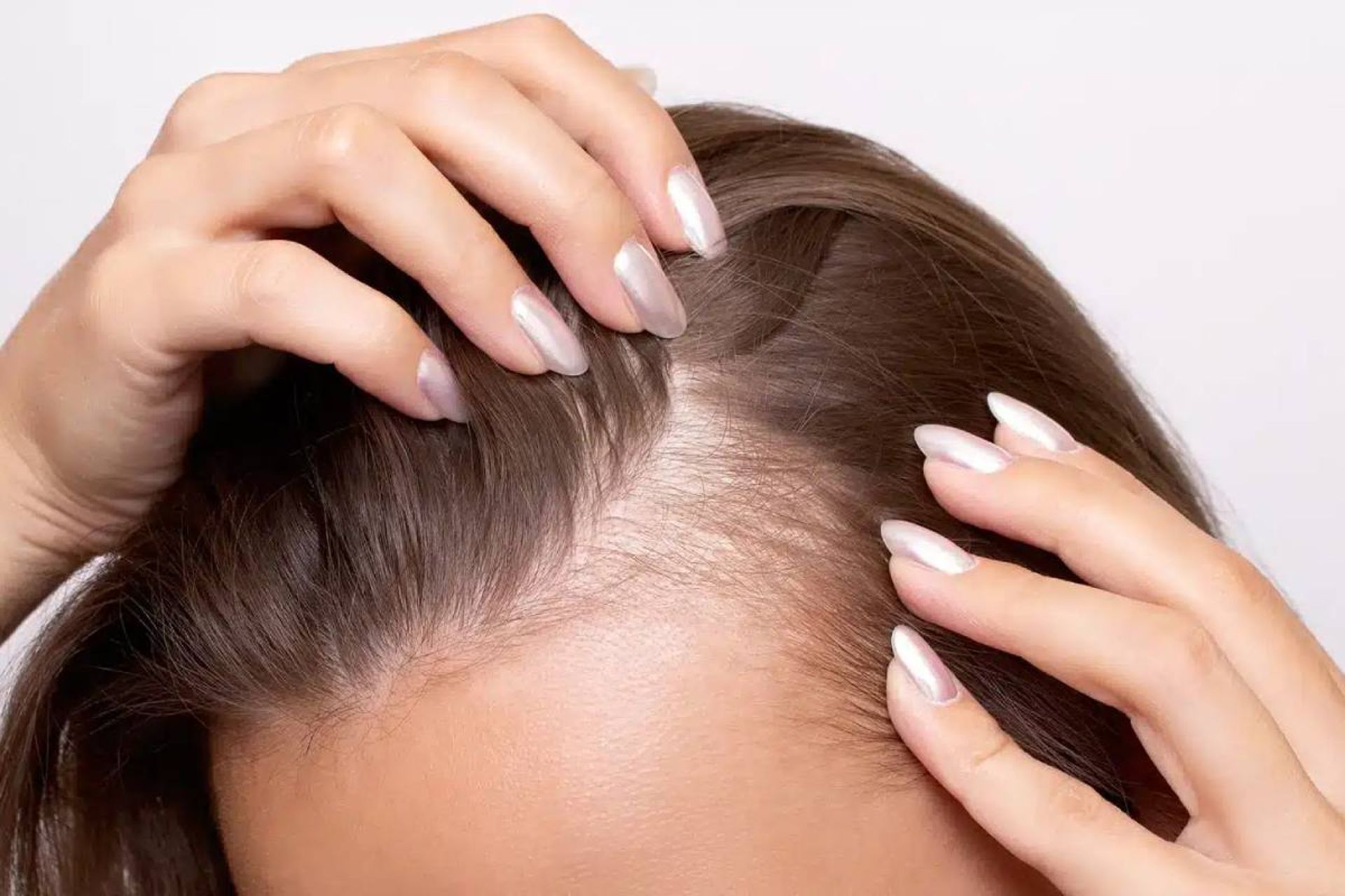 نمای نزدیک سر شخصی دچار ریزش مو