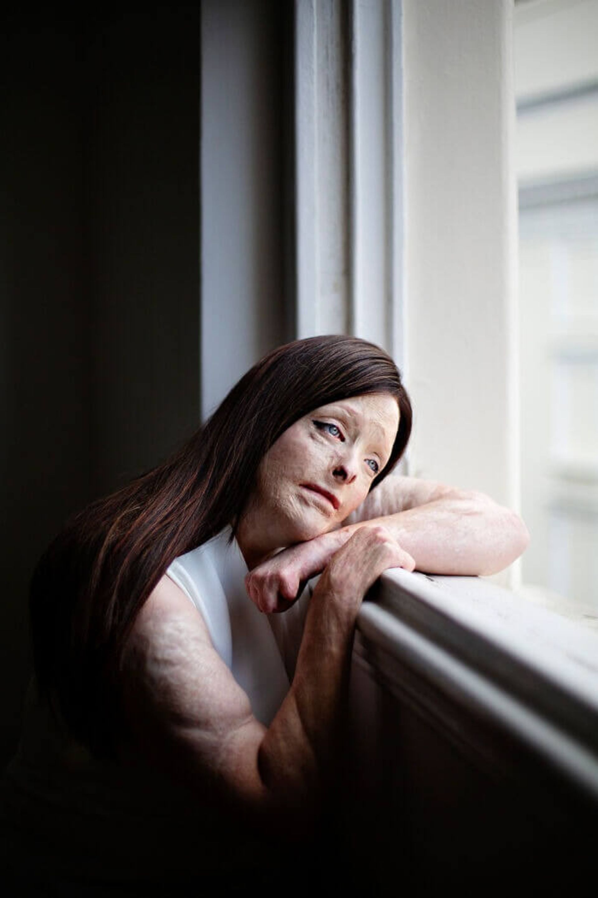 زنی با صورت اسیدپاشی شده