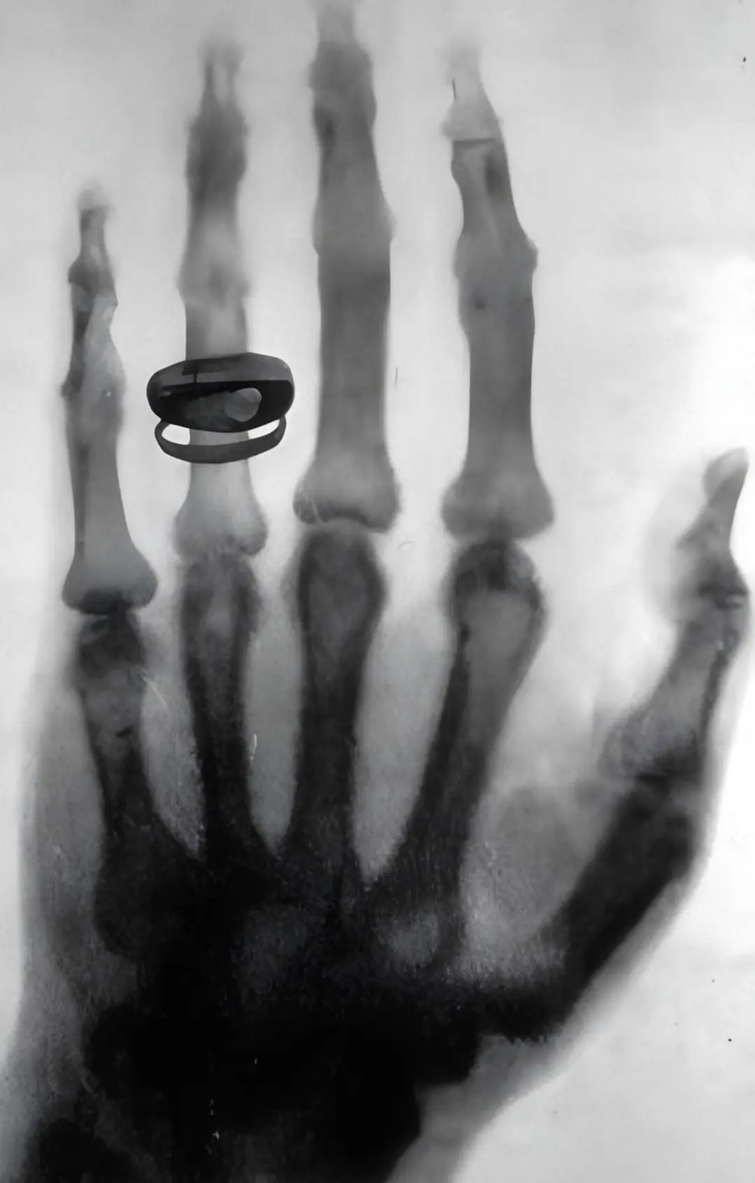 اشعه ایکس (X-ray) از یک انگشتر قرار گرفته روی انگشت دست